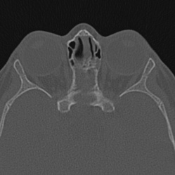 Choanal atresia (Radiopaedia 88525-105975 Axial bone window 94).jpg
