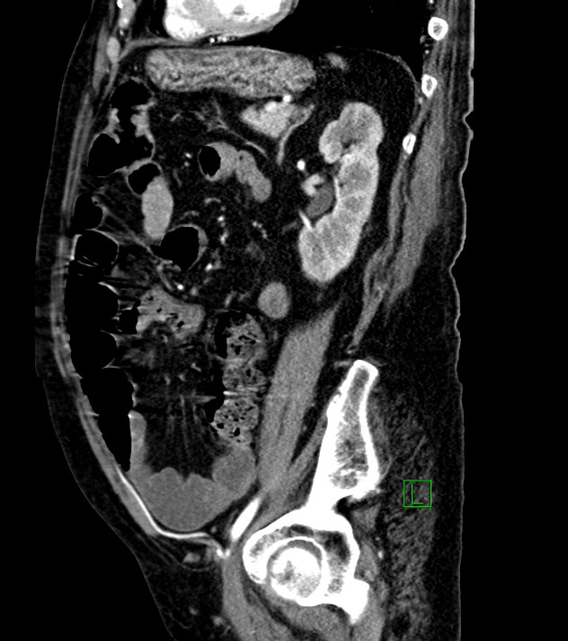 Cholangiocarcinoma with cerebral metastases (Radiopaedia 83519-98629 F 43).jpg