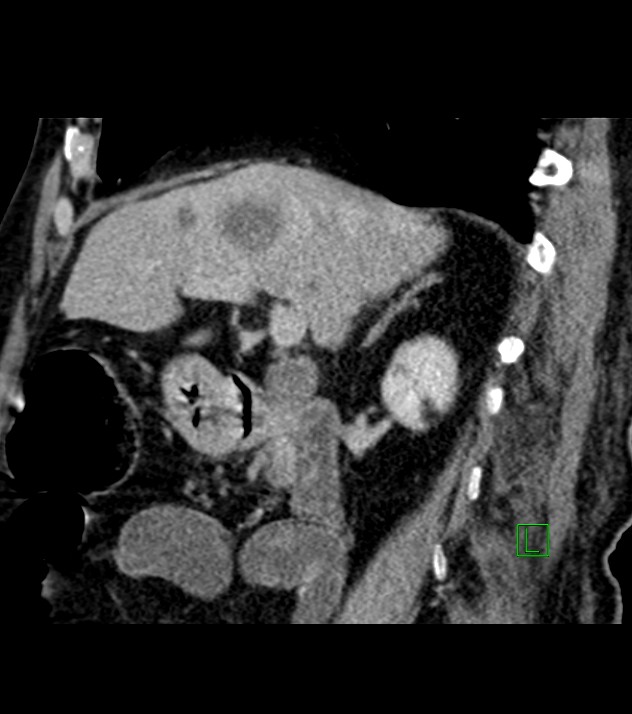 Cholangiocarcinoma with cerebral metastases (Radiopaedia 83519-98629 Sagittal C+ delayed 70).jpg