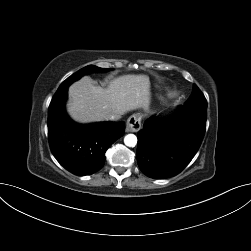 Cholecystoduodenal fistula due to calculous cholecystitis with gallstone migration (Radiopaedia 86875-103077 A 10).jpg