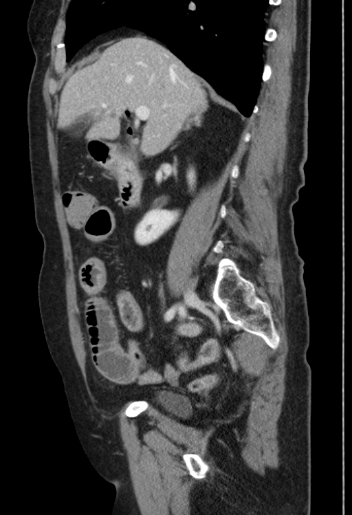 Cholecystoduodenal fistula due to calculous cholecystitis with gallstone migration (Radiopaedia 86875-103077 F 38).jpg