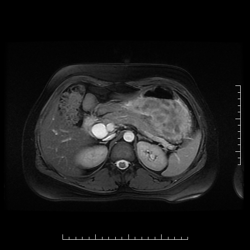 File:Choledochal cyst with chronic calcific pancreatitis (Radiopaedia 18245-18062 Axial T2 7).png
