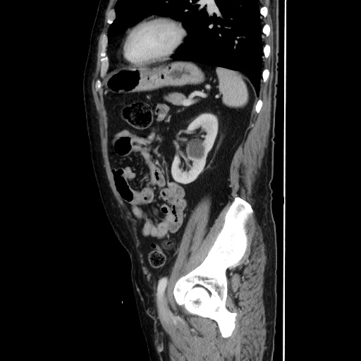 Choledocholiathiasis with normal caliber common bile duct (Radiopaedia 75368-86632 D 113).jpg