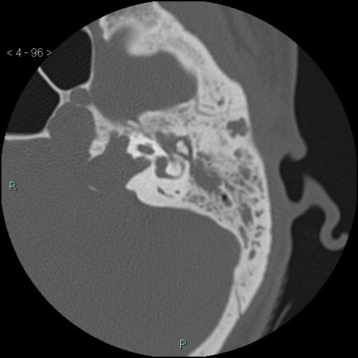 File:Cholesterol granuloma of the petrous apex (Radiopaedia 64358-73141 Axial bone window 46).jpg