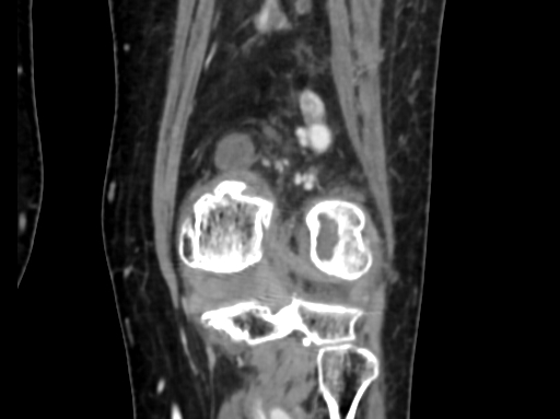 Chondrosarcoma - femur (Radiopaedia 64187-72954 C 43).jpg