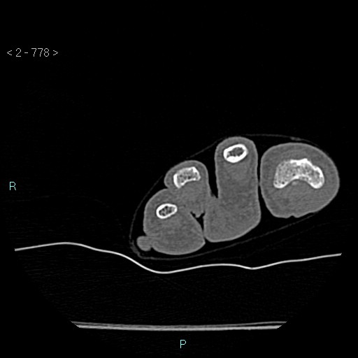 File:Chondrosarcoma - phalanx (Radiopaedia 69047-78812 Axial bone window 32).jpg