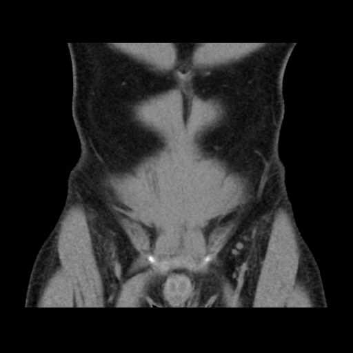 Chondrosarcoma of iliac wing (Radiopaedia 63861-72599 Coronal non-contrast 24).jpg