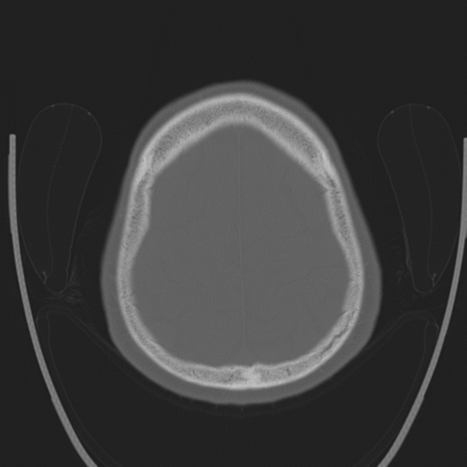 Chondrosarcoma of skull base- grade II (Radiopaedia 40948-43653 Axial bone window 41).png