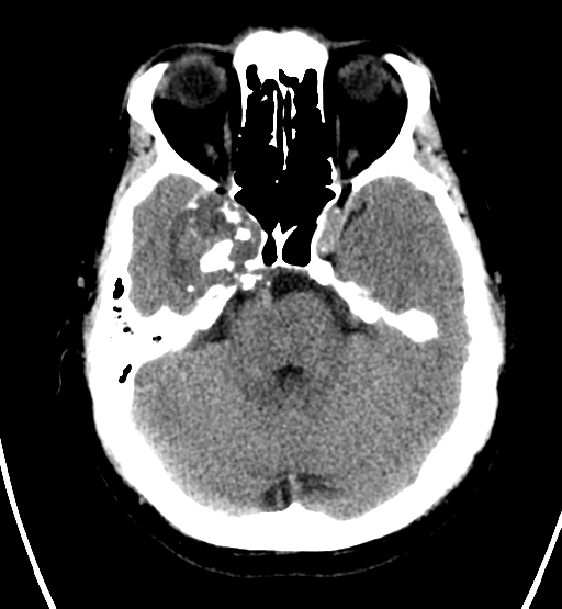 File:Chondrosarcoma of skull base- grade II (Radiopaedia 40948-43653 Axial non-contrast 9).png
