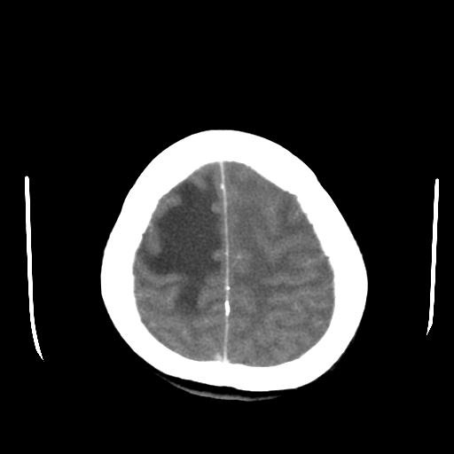 File:Choriocarcinoma of ovary with cerebral and pulmonary metastases (Radiopaedia 25983-26118 A 22).jpg