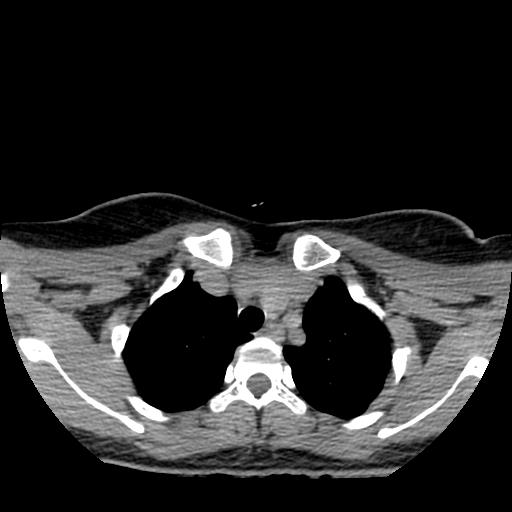 File:Choriocarcinoma of ovary with cerebral and pulmonary metastases (Radiopaedia 25983-26119 Axial non-contrast 90).jpg
