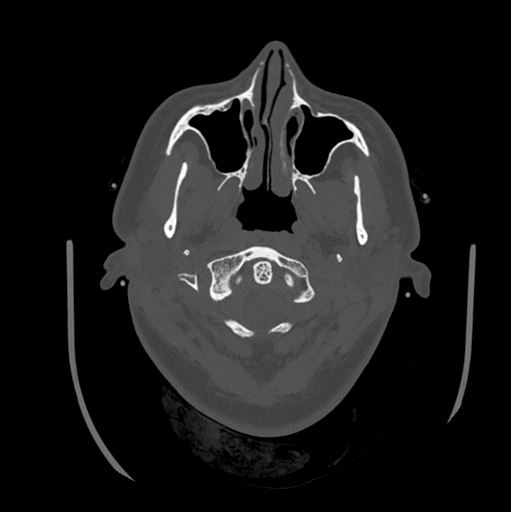 Choroid plexus papilloma extending into the cerebellopontine angle cistern (Radiopaedia 85941-101833 Axial bone window 13).png