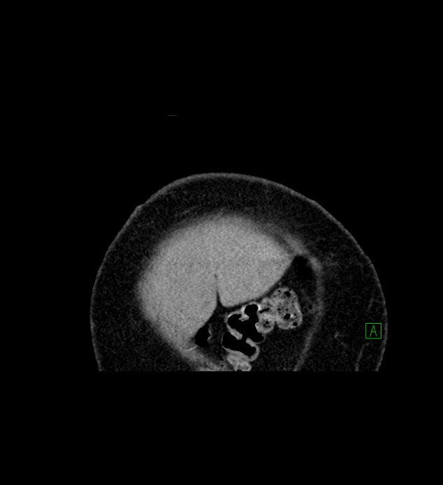 Chromophobe renal cell carcinoma (Radiopaedia 84239-99519 C 5).jpg