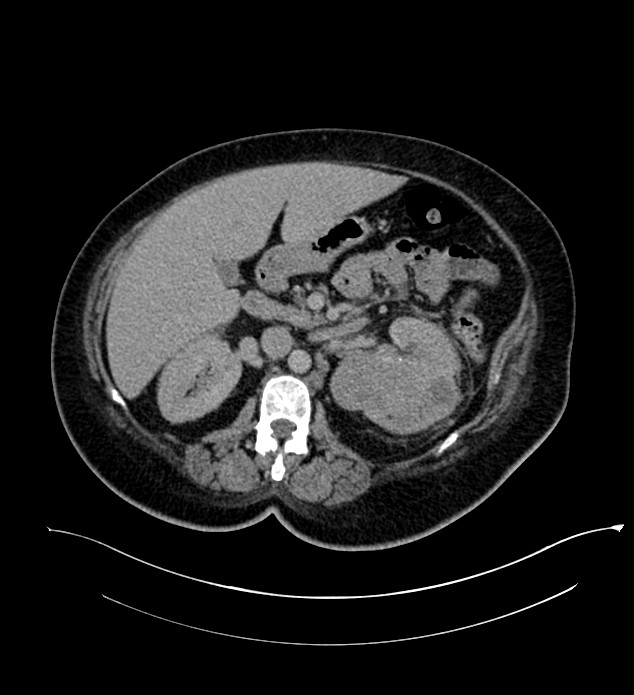 Chromophobe renal cell carcinoma (Radiopaedia 84239-99519 E 71).jpg