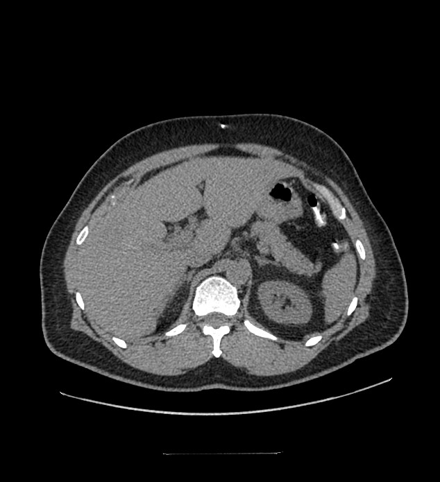 Chromophobe renal cell carcinoma (Radiopaedia 84337-99644 Axial non-contrast 26).jpg