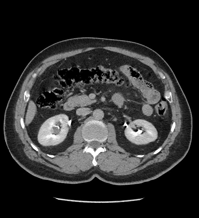 Chromophobe renal cell carcinoma (Radiopaedia 86879-103083 D 58).jpg