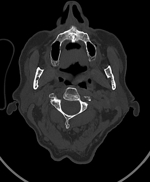 Chronic bilateral subdural hygroma (Radiopaedia 85801-101623 Axial bone window 124).jpg