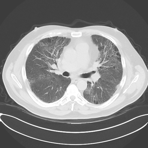 Chronic hypersensitivity pneumonitis (Radiopaedia 48107-52922 Axial lung window 30).png