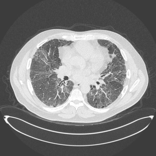 File:Chronic hypersensitivity pneumonitis (Radiopaedia 48107-52922 Coronal lung window 1).png