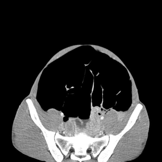 Chronic large bowel pseudo-obstruction (Radiopaedia 43181-46492 A 133).jpg