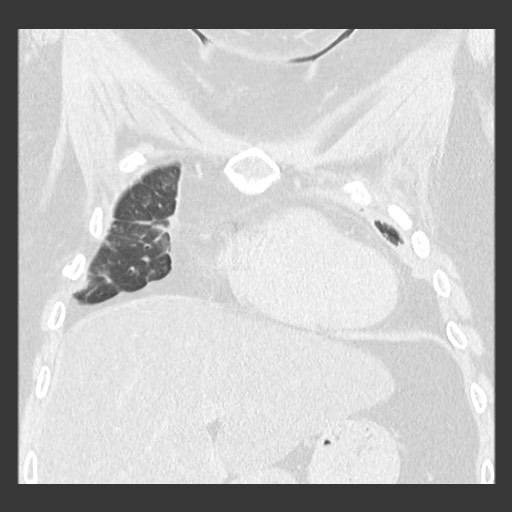 Chronic lung allograft dysfunction - restrictive form (Radiopaedia 60595-68316 Coronal lung window 33).jpg
