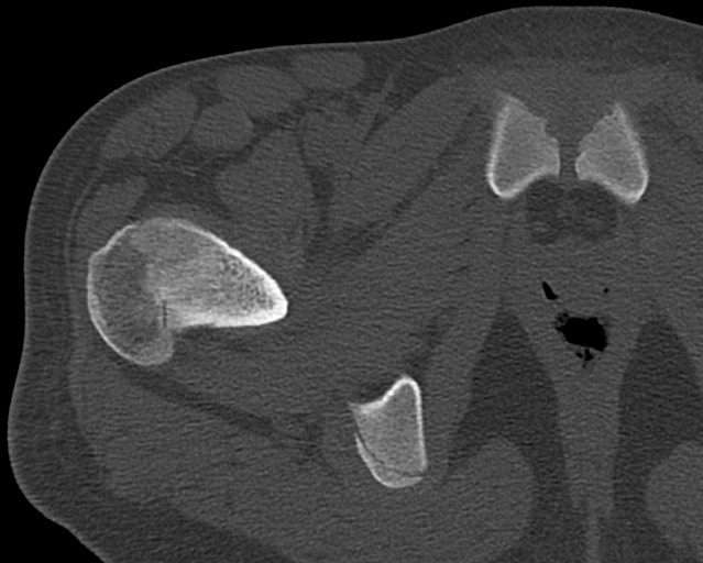 Chronic ostemyelitis of the femur with long sinus tract (Radiopaedia 74947-85982 Axial bone window 10).jpg