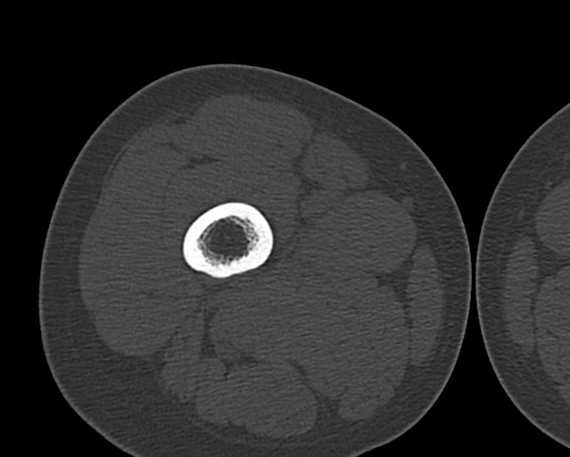 Chronic ostemyelitis of the femur with long sinus tract (Radiopaedia 74947-85982 Axial bone window 64).jpg