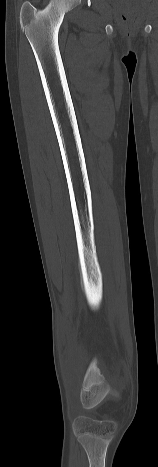 Chronic ostemyelitis of the femur with long sinus tract (Radiopaedia 74947-85982 Coronal bone window 37).jpg