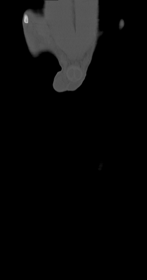 Chronic osteomyelitis (with sequestrum) (Radiopaedia 74813-85822 Coronal non-contrast 3).jpg