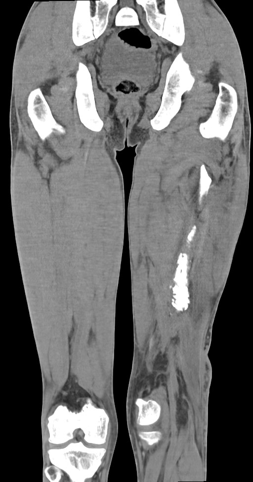 Chronic osteomyelitis (with sequestrum) (Radiopaedia 74813-85822 E 37).jpg