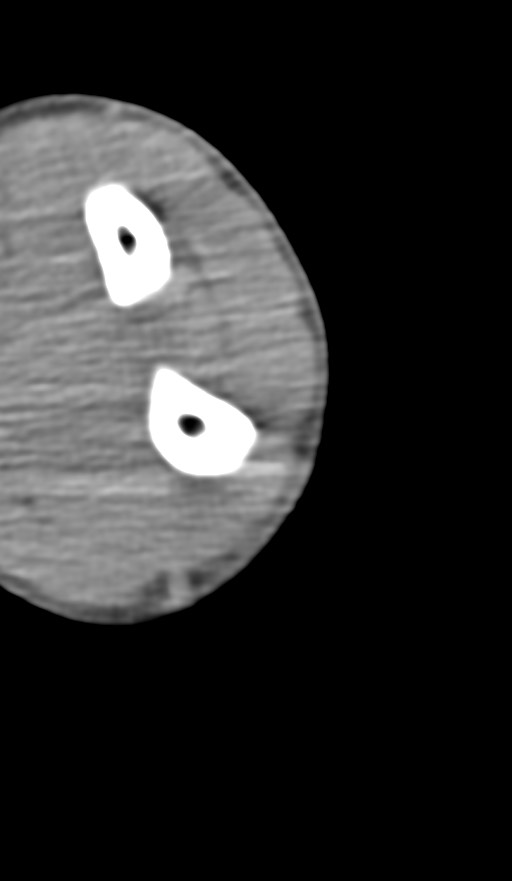Chronic osteomyelitis of the distal humerus (Radiopaedia 78351-90971 Axial non-contrast 130).jpg