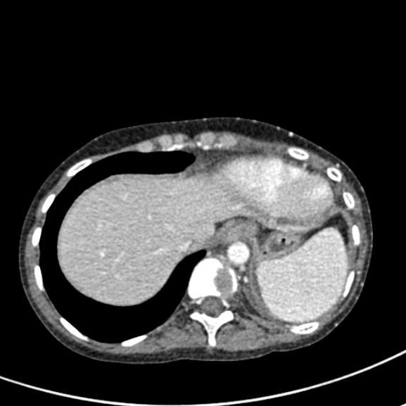 File:Chronic pancreatitis (Radiopaedia 55405-61846 A 14).jpg