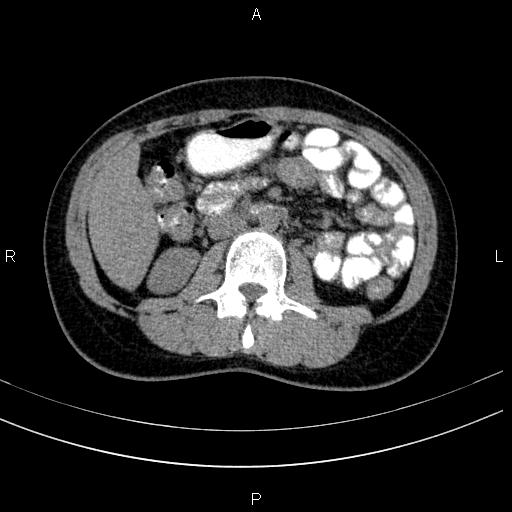 File:Chronic pancreatitis (Radiopaedia 64576-73450 Axial non-contrast 76).jpg