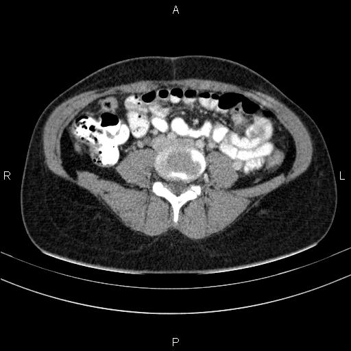 File:Chronic pancreatitis (Radiopaedia 64576-73450 C 105).jpg