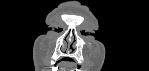 Chronic sphenoidal sinusitis (Radiopaedia 62030-70122 Coronal bone window 11).jpg