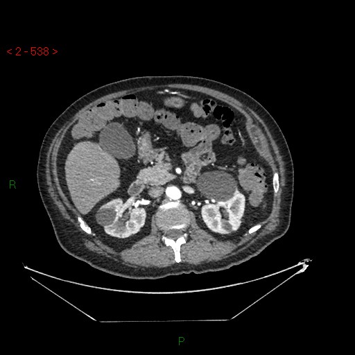 Circumaortic left renal vein and doubled left renal arteries (Radiopaedia 52268-58158 A 74).jpg