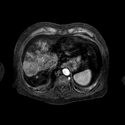 Cirrhosis and hepatocellular carcinoma in the setting of hemochromatosis (Radiopaedia 75394-86594 Axial T1 C+ fat sat 148).jpg