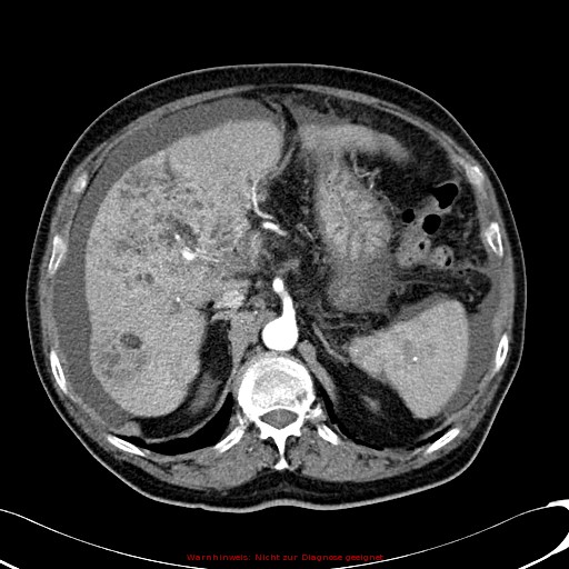 File:Cirrhosis and hepatocellular carcinoma in the setting of hemochromatosis (Radiopaedia 75394-86595 A 29).jpg