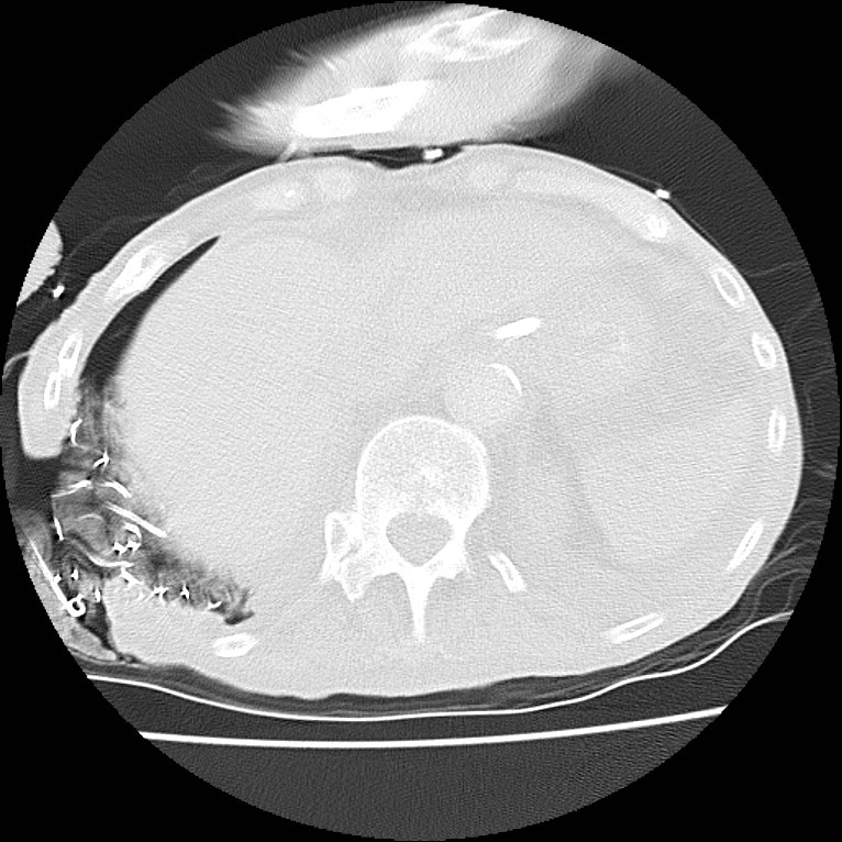 Clagett thoracotomy with bronchopleural fistula (Radiopaedia 29192-29587 Axial lung window 47).jpg