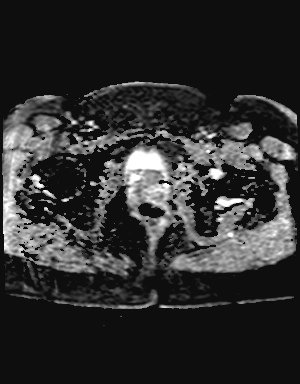 File:Class II Mullerian duct anomaly- unicornuate uterus with rudimentary horn and non-communicating cavity (Radiopaedia 39441-41755 Axial ADC 24).jpg