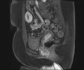 File:Class II Mullerian duct anomaly- unicornuate uterus with rudimentary horn and non-communicating cavity (Radiopaedia 39441-41755 G 45).jpg