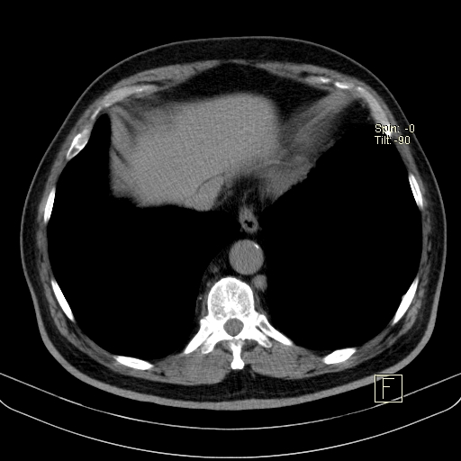 File:Classic complicated silicosis (Radiopaedia 49720-54961 Axial liver window 46).jpg
