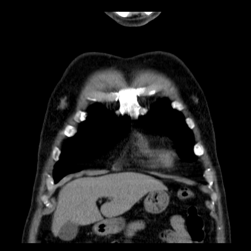File:Classic complicated silicosis (Radiopaedia 49720-54961 Coronal liver window 5).jpg