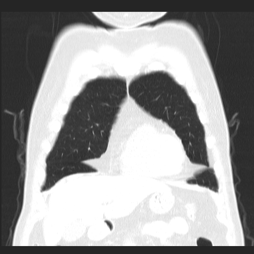 File:Classic complicated silicosis (Radiopaedia 49720-54961 Coronal lung window 11).jpg