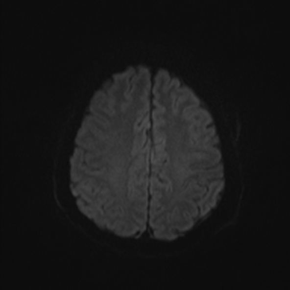File:Clival meningioma (Radiopaedia 53278-59248 Axial DWI 44).jpg