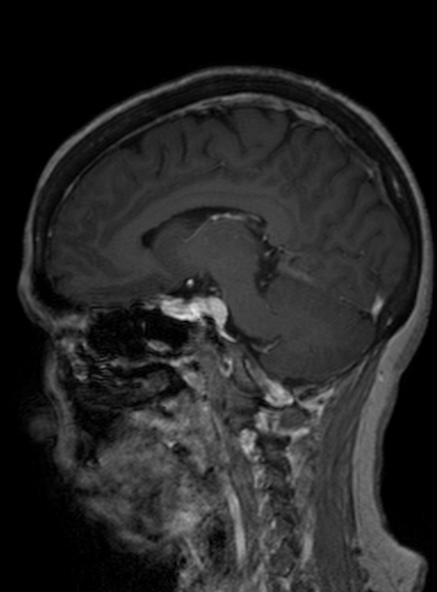 Clival meningioma (Radiopaedia 53278-59248 Sagittal T1 C+ 277).jpg