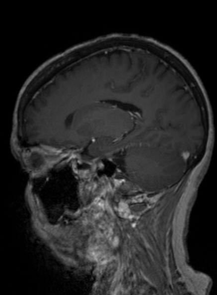 Clival meningioma (Radiopaedia 53278-59248 Sagittal T1 C+ 291).jpg