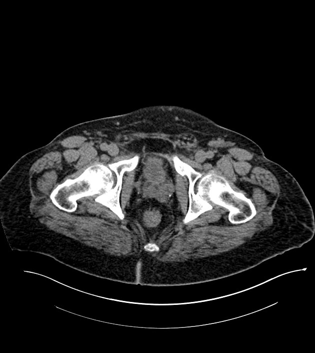 Closed-loop small bowel obstruction-internal hernia (Radiopaedia 78439-91096 Axial non-contrast 151).jpg