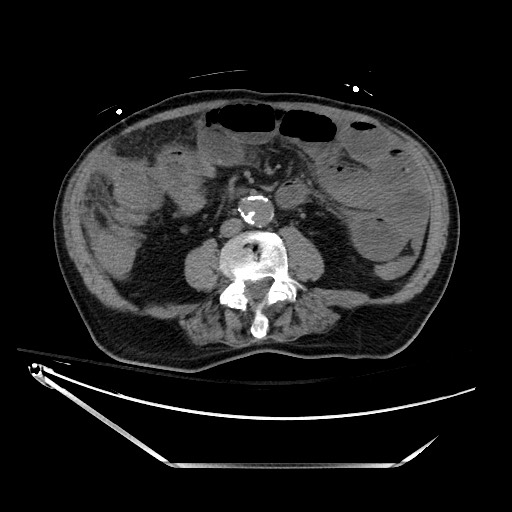 File:Closed loop obstruction due to adhesive band, resulting in small bowel ischemia and resection (Radiopaedia 83835-99023 Axial non-contrast 85).jpg