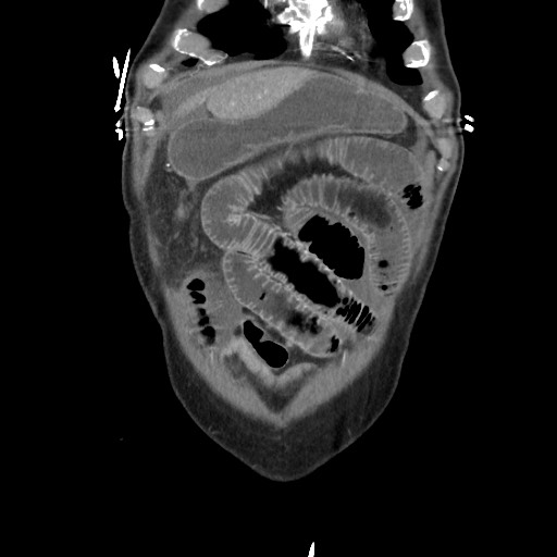 File:Closed loop obstruction due to adhesive band, resulting in small bowel ischemia and resection (Radiopaedia 83835-99023 C 26).jpg